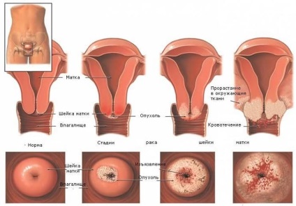 Câți trăiesc cu cancer de col uterin în 1 etapă, 2, 3 și 4 grade