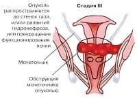 Câți trăiesc cu cancer de col uterin în 1 etapă, 2, 3 și 4 grade