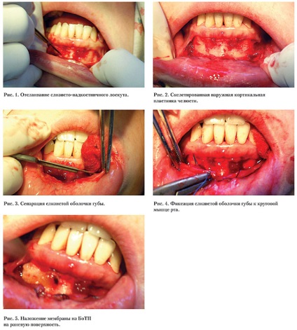 Metodă de vestibuloplastie articole moderne stomatologie medicină