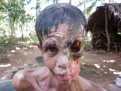 Trópusi fertőzések evett fele az arc lakosok Sri Lanka (fotó), a női magazin onlan