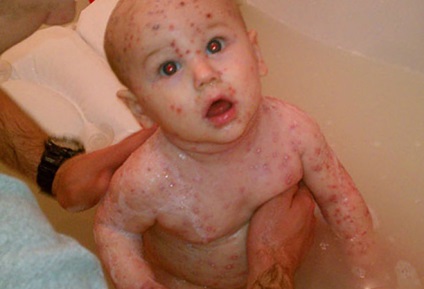 Varicela - fotografii ale erupțiilor cutanate, simptome de varicelă la copii și adulți