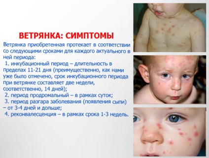 Varicela - fotografii ale erupțiilor cutanate, simptome de varicelă la copii și adulți