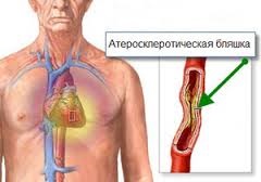 Tipuri de angină pectorală, simptome și tratamentul durerii cardiace