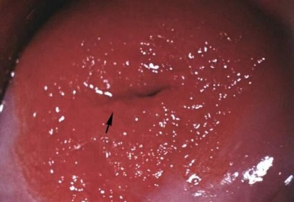 Eroziunea congenitală a colului uterin