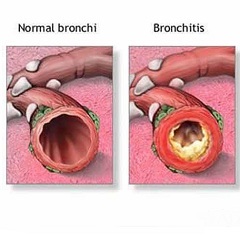 Bronsita cronică - tratament, simptome, exacerbare