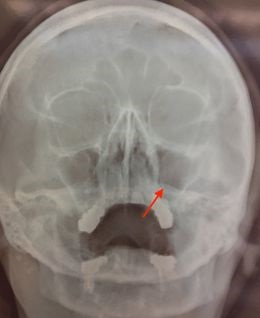 Sinuzita maxilară cronică purulentă - tratament la Moscova fără perforări în clinica - medicul ENT