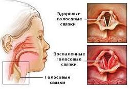 Boli ale corzilor vocale - diagnostic și tratament în Clinica Goethe