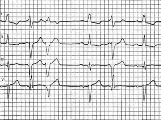 Ventricular extrasystoles pe zi și cum să scapi de problemă