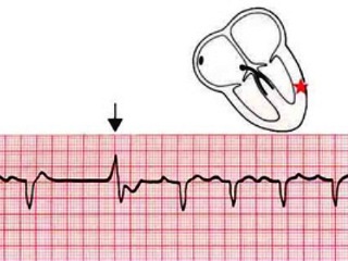 Ventricular extrasystoles pe zi și cum să scapi de problemă