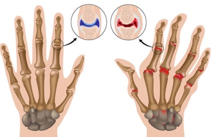 7 Remedii care vor ameliora simptomele artritei