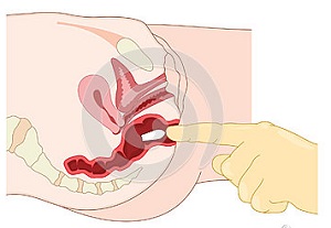 Adenomul prostatei fără tratament chirurgical cu medicamente