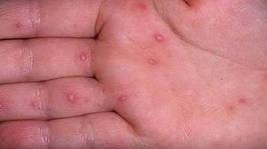 Alergii pe palmele unui copil, simptome, tratament, fotografie