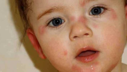Alergia la lapte în simptomele unui copil, fotografie