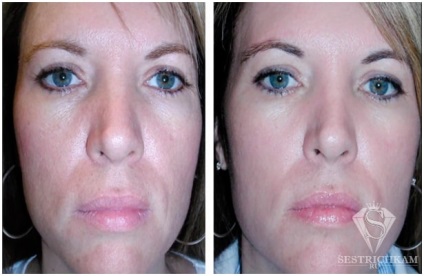 Diamond Face Peeling отзывы, fotografie înainte și după, video