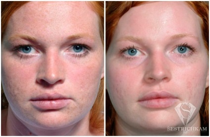 Diamond Face Peeling отзывы, fotografie înainte și după, video