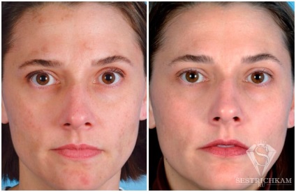 Diamond Face Peeling отзывы, fotografie înainte și după, video