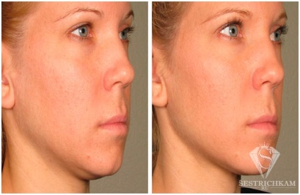 Diamond Face Peeling отзывы, fotografie înainte și după, video