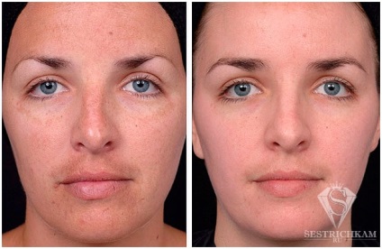 Diamond Face Peeling отзывы, fotografie înainte și după, video