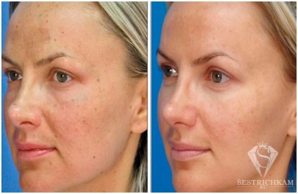 Diamond Face Peeling отзывы, fotografie înainte și după, video