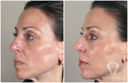 Diamond Face Peeling отзывы, fotografie înainte și după, video