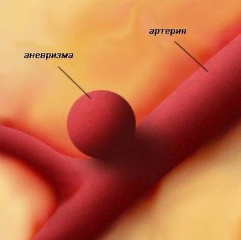 Agyi aneurizma, mi az, tünetek, okok és osztályozása