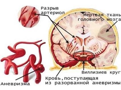 Un anevrism al vaselor cerebrale ce este, simptome, cauze și clasificare