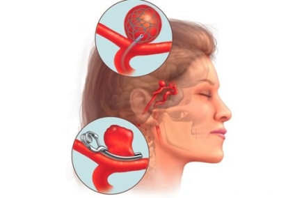 Un anevrism al vaselor cerebrale ce este, simptome, cauze și clasificare
