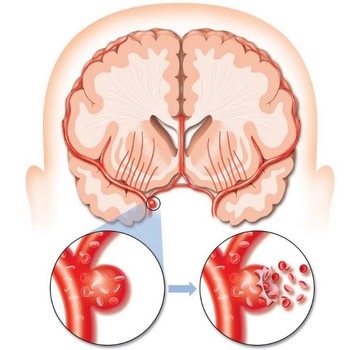 Un anevrism al vaselor cerebrale ce este, simptome, cauze și clasificare