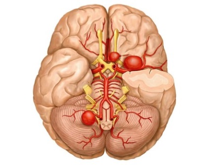 Un anevrism al vaselor cerebrale ce este, simptome, cauze și clasificare