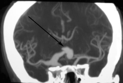 Un anevrism al vaselor cerebrale ce este, simptome, cauze și clasificare