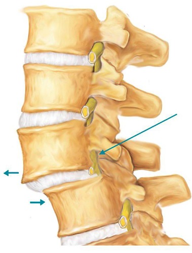Antelisteza vertebrelor (coloanei vertebrale) că acest tratament, gradul