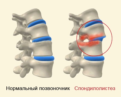 Antelisteza vertebrelor (coloanei vertebrale) că acest tratament, gradul