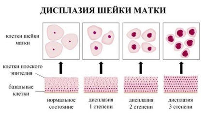 Boli ale colului uterin