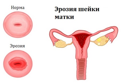 Boli ale colului uterin