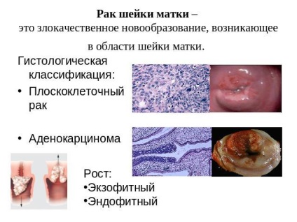 Boli ale colului uterin