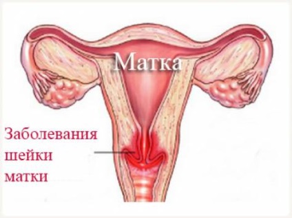 Boli ale colului uterin