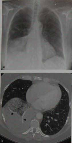 Bronchioloalveolar (celule alveolare)