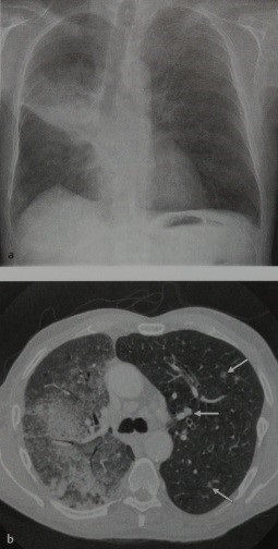 Bronchioloalveolar (celule alveolare)