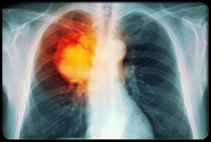 Primul simptom al cancerului pulmonar bronhoalveolar și tratamentul