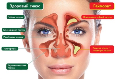 Mi van, ha meghatározott fülét a szinusz okait, kiváltó, kezelés