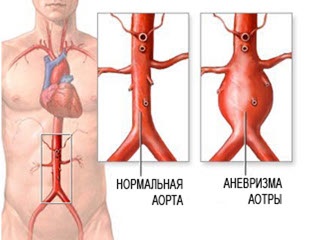 Care este anevrismul aortei și creierului? Diagnosticul și tratamentul rupturii unui anevrism în cap