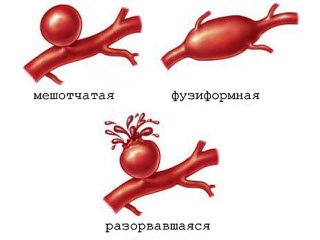 Care este anevrismul aortei și creierului? Diagnosticul și tratamentul rupturii unui anevrism în cap