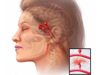 Care este anevrismul aortei și creierului? Diagnosticul și tratamentul rupturii unui anevrism în cap