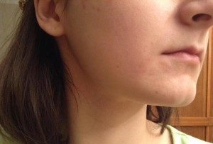 Differin de acnee recenzii, manual de utilizare