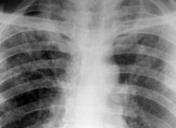 Tuberculoza diseminată