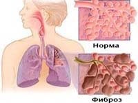 Alveolita fibroza - cauze, simptome, diagnostic și tratament