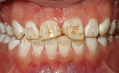 Fluorizarea dinților sugarilor la copii