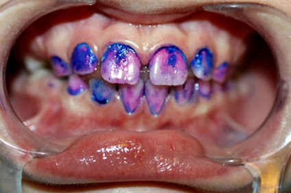 Fluorizarea dinților sugarilor la un copil, indicații și contraindicații