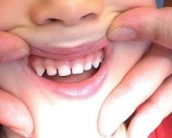 Fluorizarea dinților la copii și metode moderne de procedură