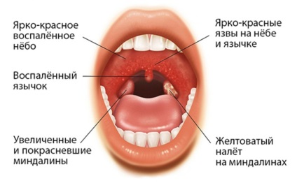 Herpesul dureros în gât (tratament, simptome), cum este tratată amigdalita herpetică